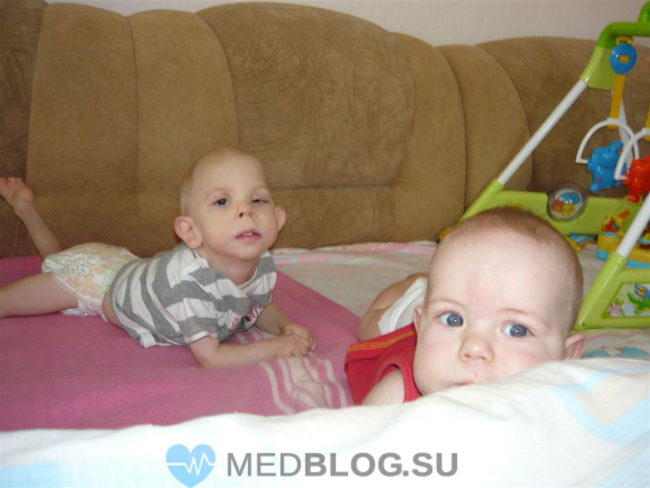 Диагностика синдрома Опица