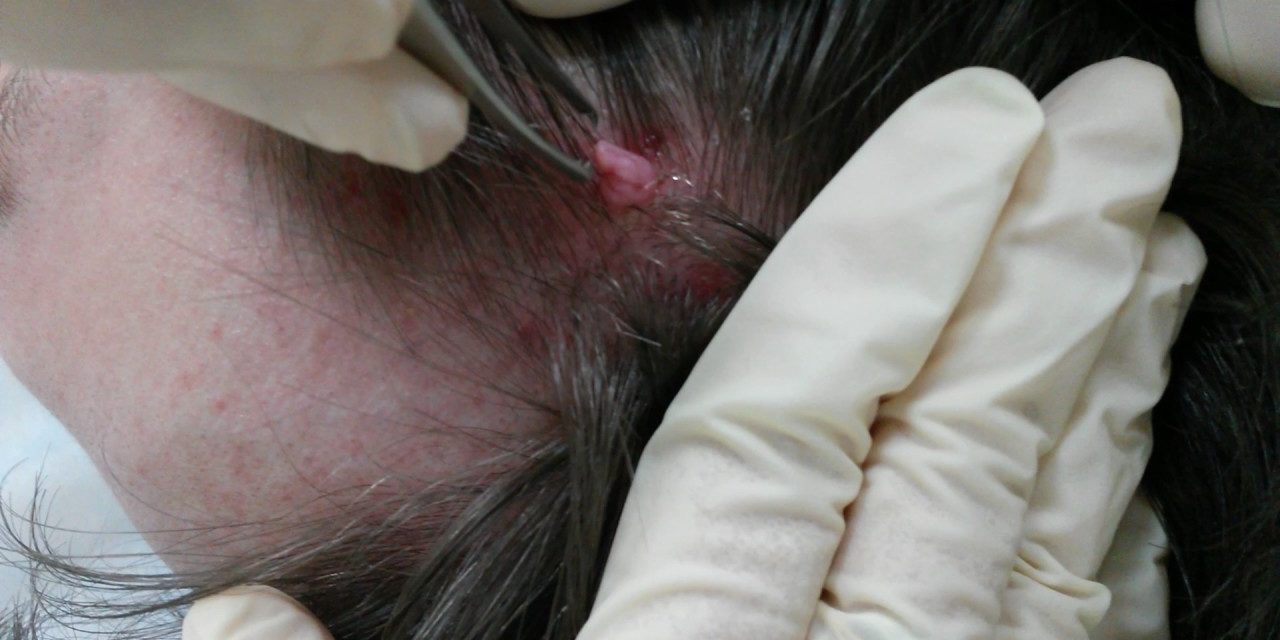 Радиоволновое удаление папилломы волосистой части головы