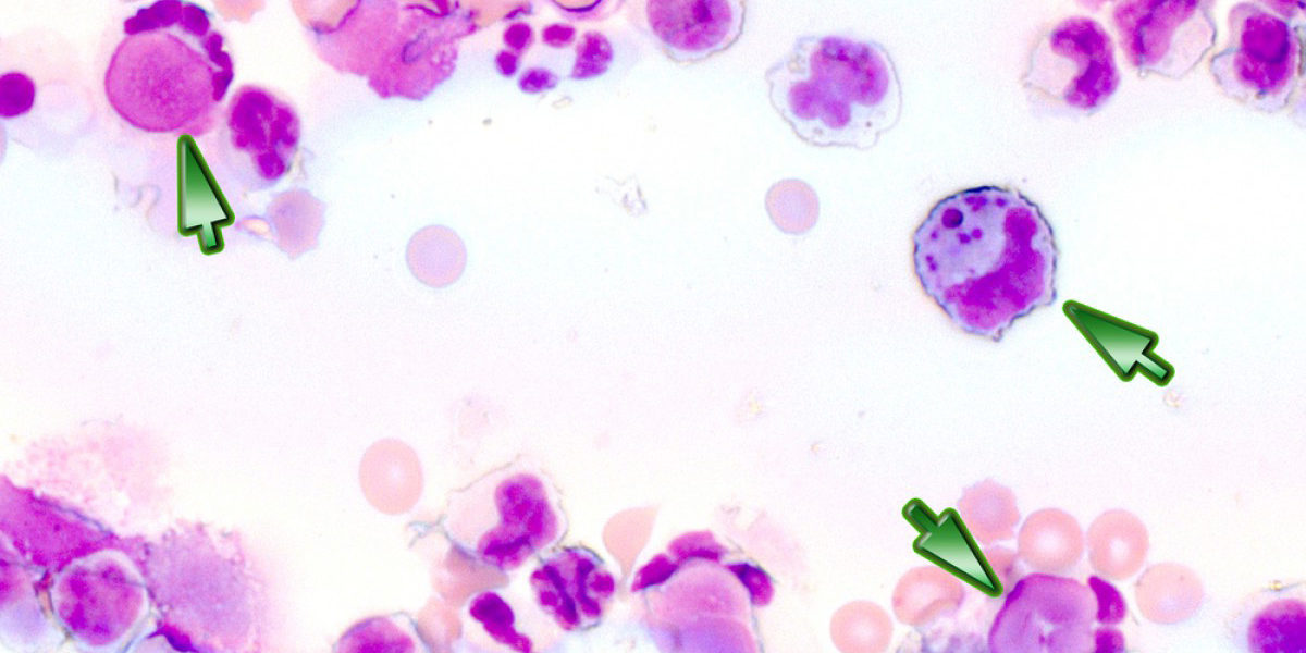 Системная красная волчанка