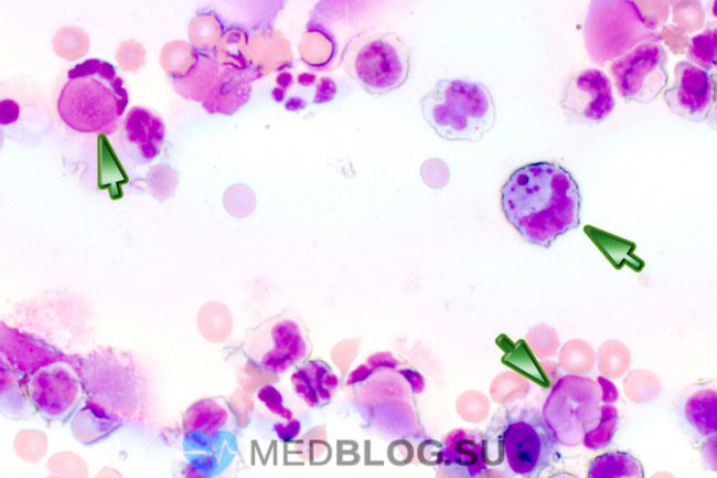 Системная красная волчанка Системная красная волчанка