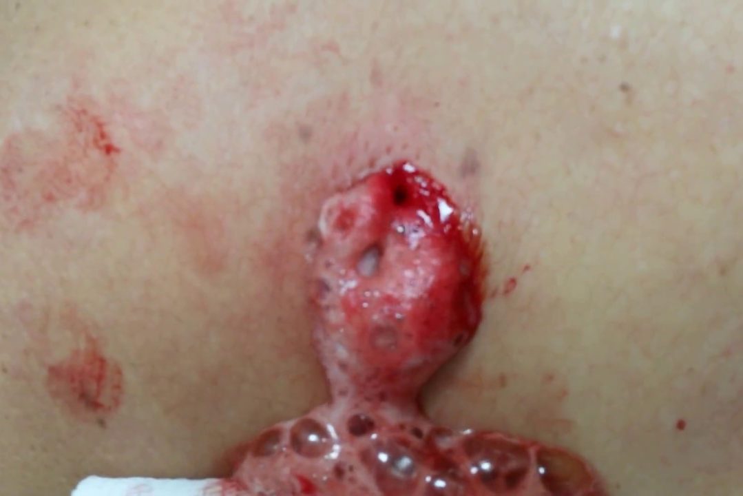 Удаление воспаленной атеромы с наложением швов