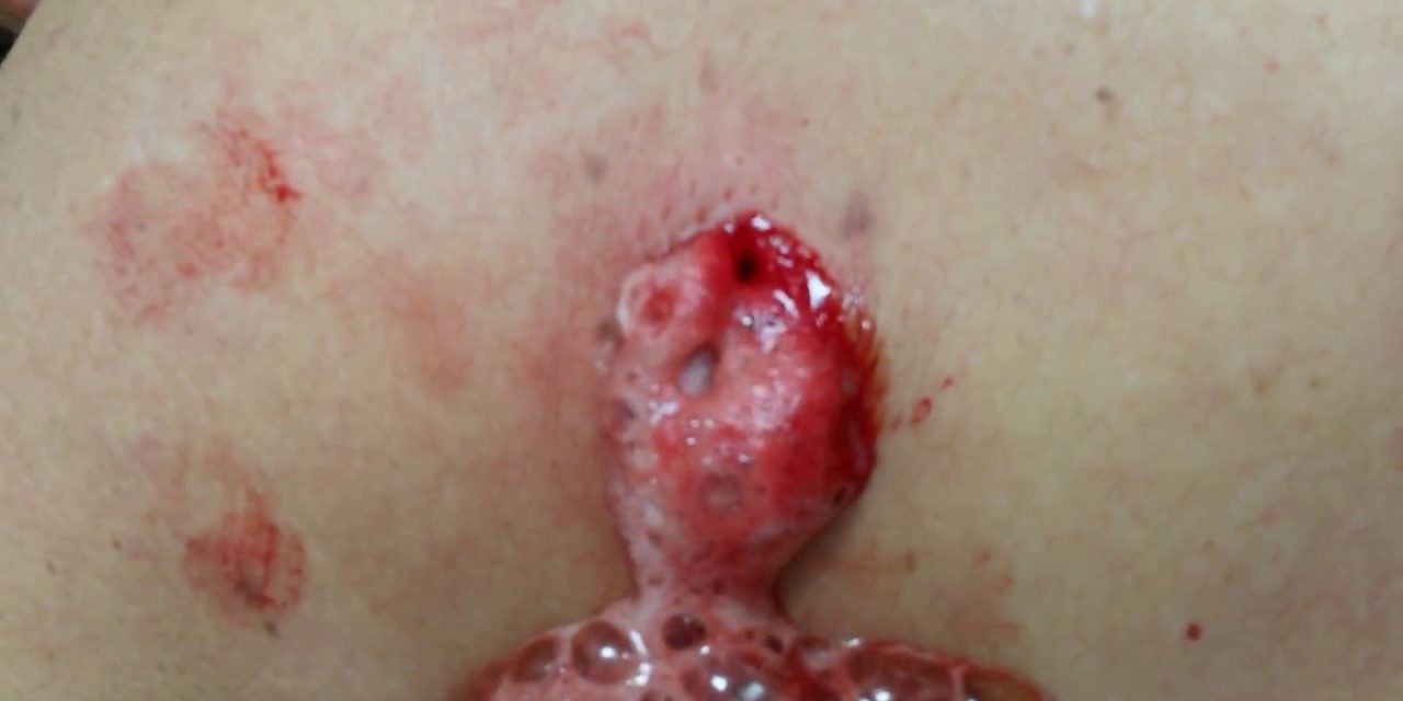 Удаление воспаленной атеромы с наложением швов