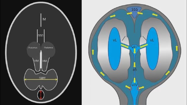 Ультразвуковая анатомия головного мозга плода