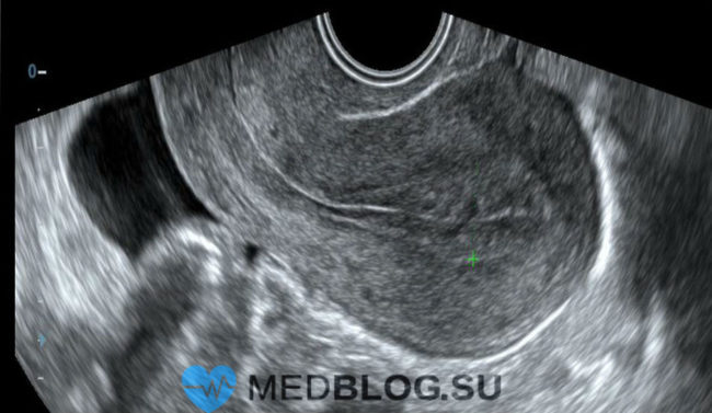 Рубец на матке