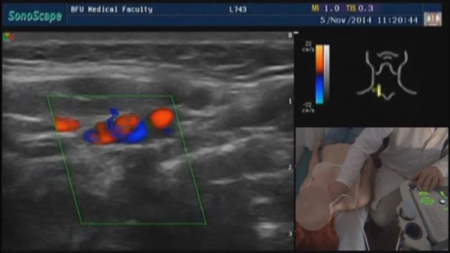 УЗИ сосудов шеи