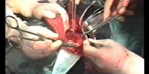 Забрюшинные неорганные опухоли — retroperitoneal tumor.avi