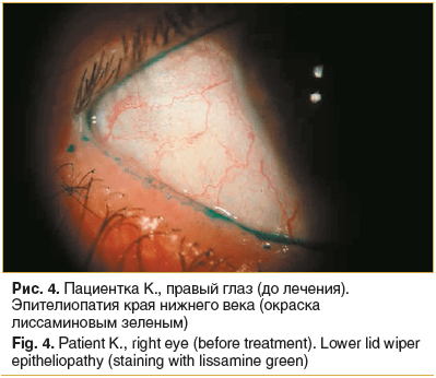 Рис. 4. Пациентка К., правый глаз (до лечения). Эпителиопатия края нижнего века (окраска лиссаминовым зеленым)
