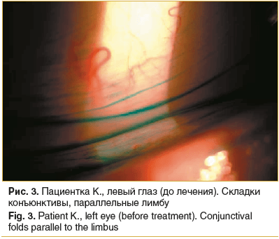 Рис. 3. Пациентка К., левый глаз (до лечения). Складки конъюнктивы, параллельные лимбу