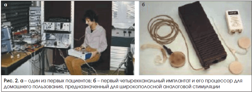 Рис. 2. a – один из первых пациентов; б – первый четырехканальный имплантат и его процессор для домашнего пользования, предназначенный для широкополосной аналоговой стимуляции