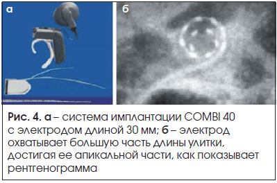 Рис. 4. а – система имплантации COMBI 40 с электродом длиной 30 мм; б – электрод охватывает большую часть длины улитки, достигая ее апикальной части, как показывает рентгенограмма