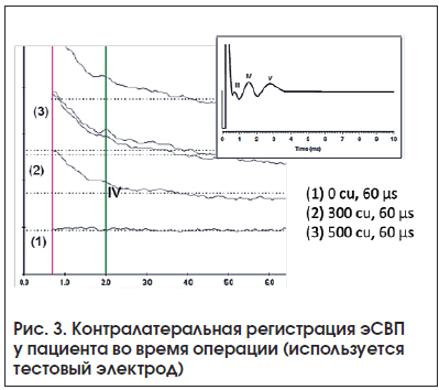 Рис. 3. Контралатеральная регистрация эСВП у пациента во время операции (используется тестовый электрод)