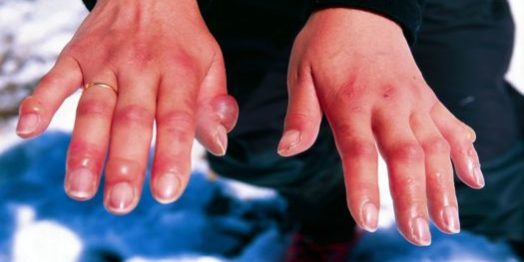 Медики рассказали, чем грозит обморожение