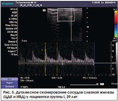 Рис. 5. Дуплексное сканирование сосудов слезной железы (ЦДК и ИВД) у пациентки группы I, 29 лет
