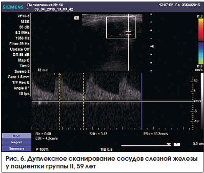 Рис. 6. Дуплексное сканирование сосудов слезной железы у пациентки группы II, 59 лет