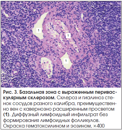 Рис. 3. Базальная зона с выраженным периваскулярным склерозом