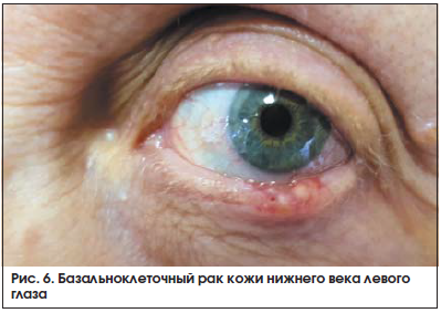 Рис. 6. Базальноклеточный рак кожи нижнего века левого глаза