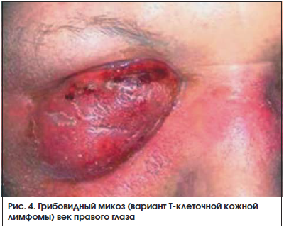 Рис. 4. Грибовидный микоз (вариант Т-клеточной кожной лимфомы) век правого глаза