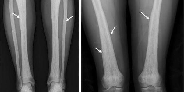 Как понять, что вам не хватает железа?