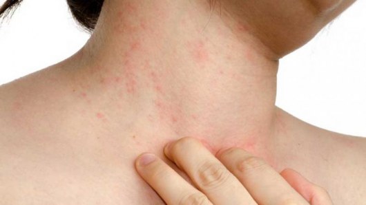 Симптомы герпетиформного дерматита Дюринга — Медицина 2.0