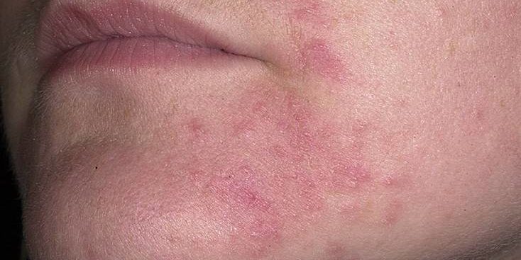 Себорейный дерматит и его признаки
