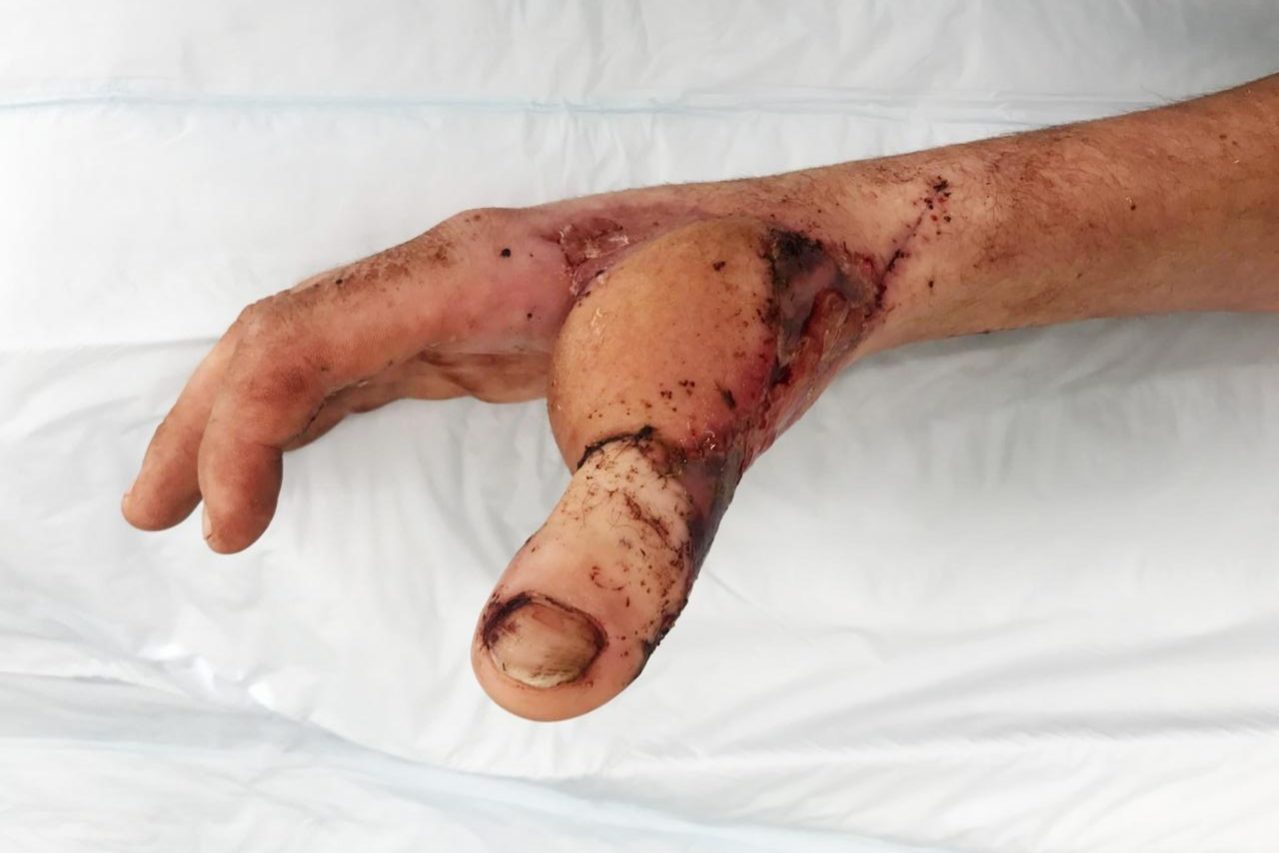 Хирурги пересадили пациенту палец ноги на руку