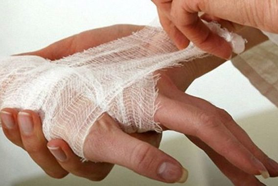 Первая помощь при ожогах горячей водой