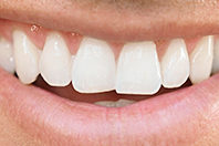 Эксперты: виниры — простой и эффективный способ получить красивую улыбку