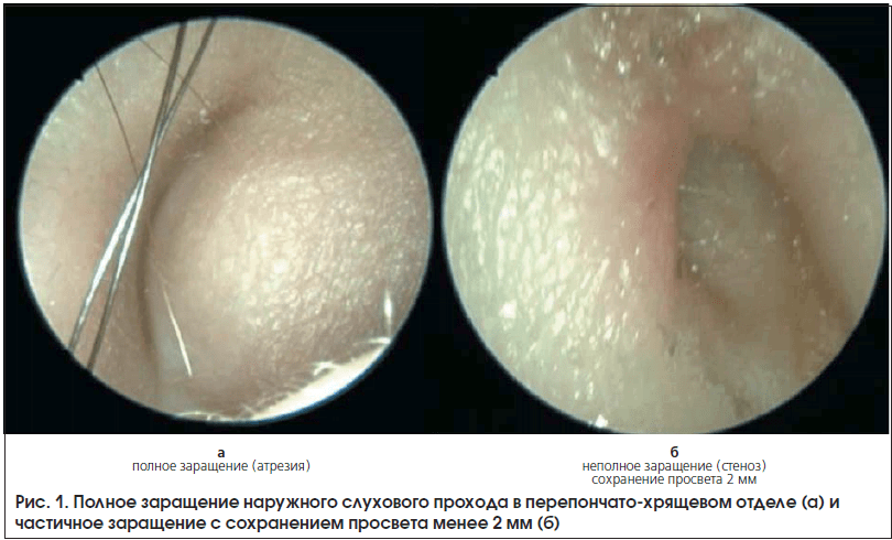 Рис. 1. Полное заращение наружного слухового прохода в перепончато-хрящевом отделе (а) и частичное заращение с сохранением просвета менее 2 мм (б)