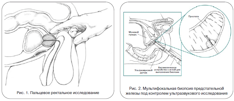 Рис. 1. Пальцевое ректальное исследование. Рис. 2. Мультифокальная биопсия предстательной железы под контролем ультразвукового исследования