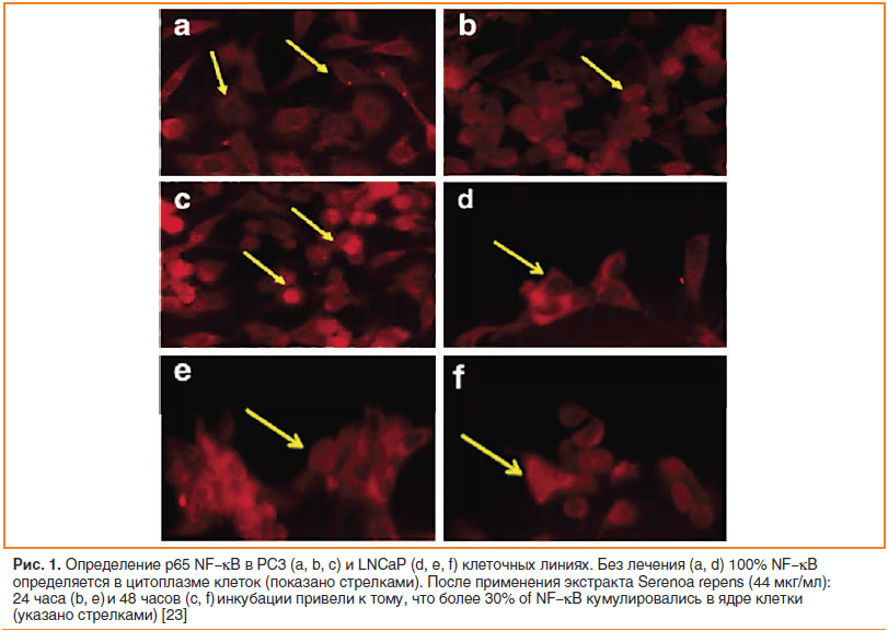 Рис. 1. Определение p65 NF-κB в PC3 (a, b, c) и LNCaP (d, e, f) клеточных линиях. Без лечения (a, d) 100% NF-κB определяется в цитоплазме клеток (показано стрелками).