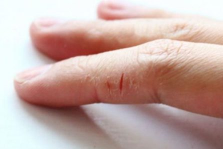 Почему на руках трескается кожа?