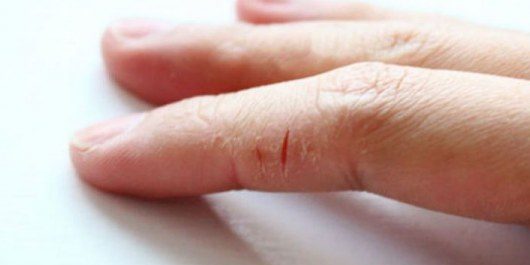 Почему на руках трескается кожа?