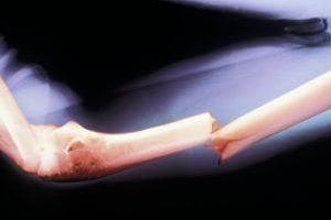 Ученые определили ген, ответственный за риск переломов