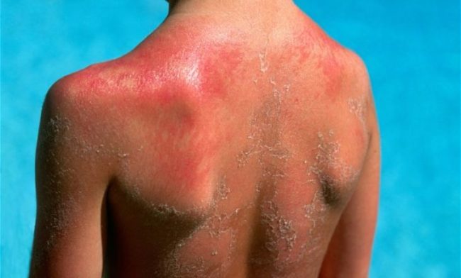 От загара до солнечного ожога: в чем опасность, чем грозит?