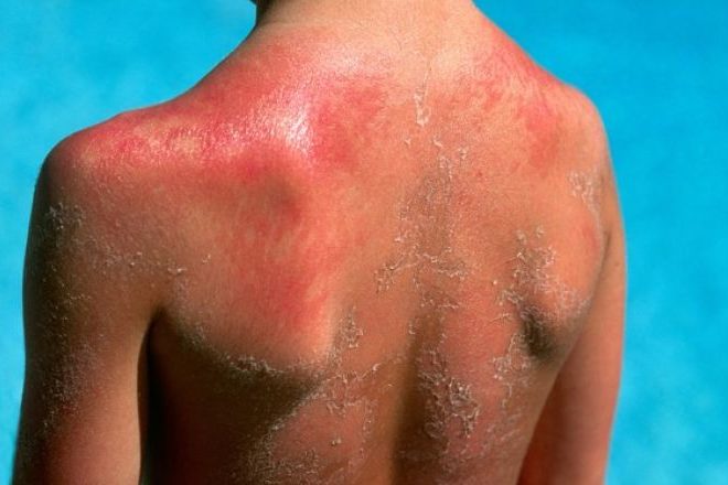 От загара до солнечного ожога: в чем опасность, чем грозит?