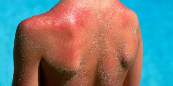 От загара до солнечного ожога: в чем опасность, чем грозит?