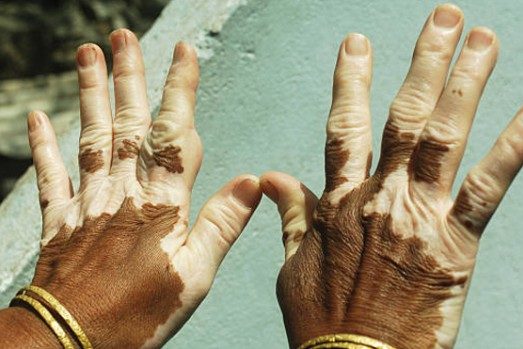 Гомеопатия может помочь бороться с витилиго