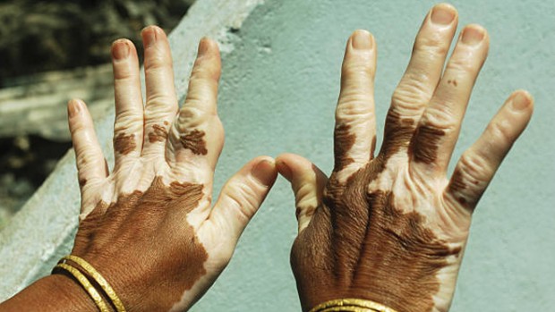 Гомеопатия может помочь бороться с витилиго