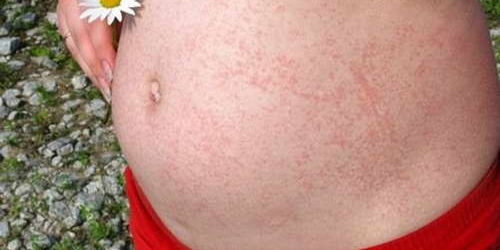 Как предотвратить аллергию на солнце?