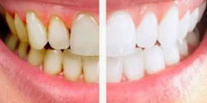 Стоматологи рассказали, как бороться с зубным камнем