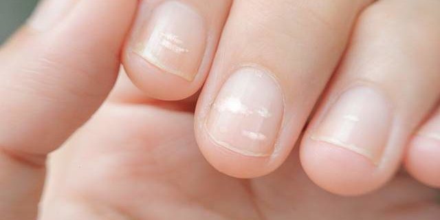 Медики объяснили, из-за чего могут появиться белые пятна на ногтях