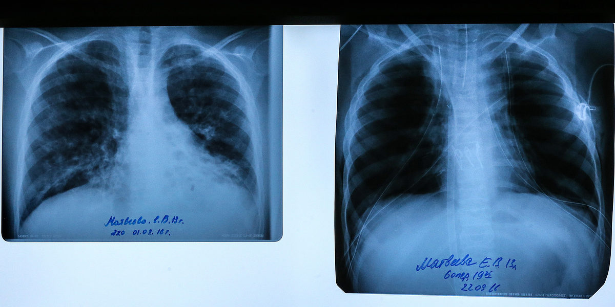 Врачи в Подмосковье впервые в России внедрили новую методику диагностики муковисцидоза — Общество