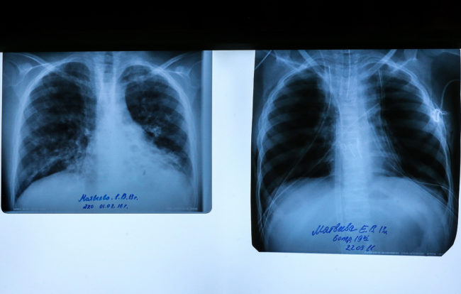 Врачи в Подмосковье впервые в России внедрили новую методику диагностики муковисцидоза — Общество