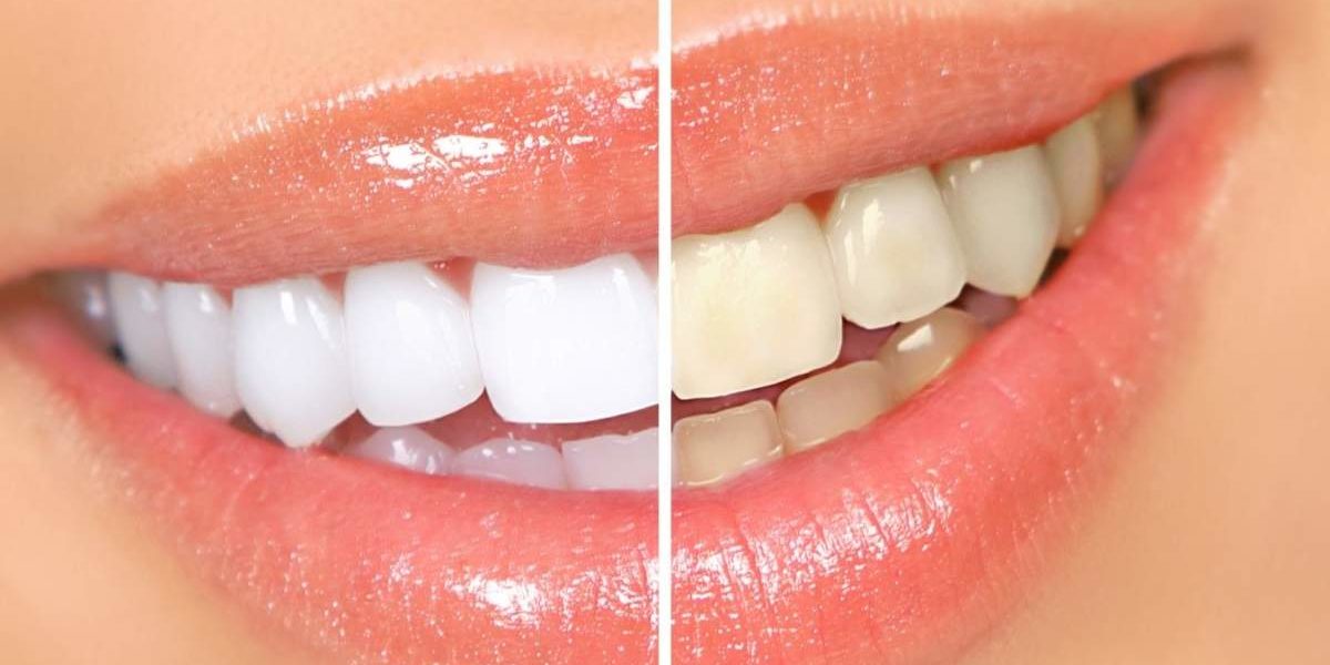 Простые способы самостоятельно отбелить зубы