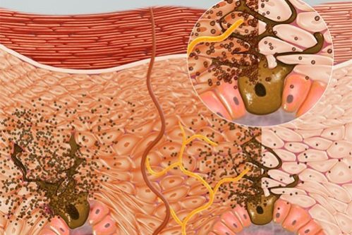 Подсчитано, насколько регулярное использование защиты от солнца снижает риск меланомы — МедНовости