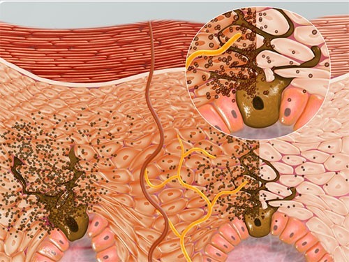 Подсчитано, насколько регулярное использование защиты от солнца снижает риск меланомы — МедНовости