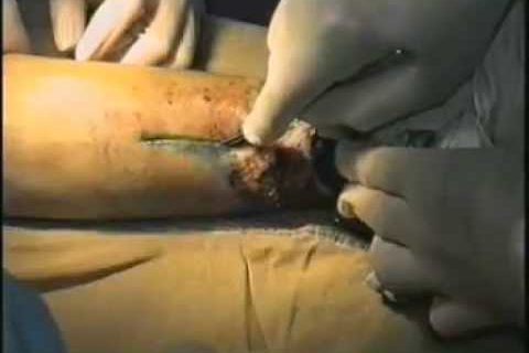 Ампутация нижней конечности amputation of foot