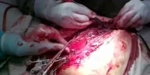 Анаэробная флегмона правой ягодичной области