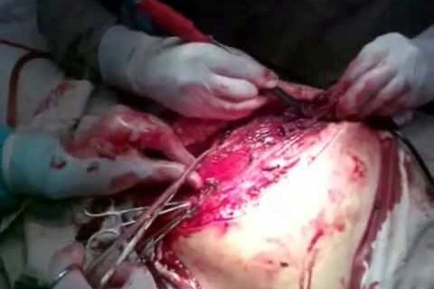 Анаэробная флегмона правой ягодичной области