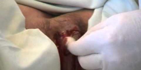 Гидраденит  — hydradenitis